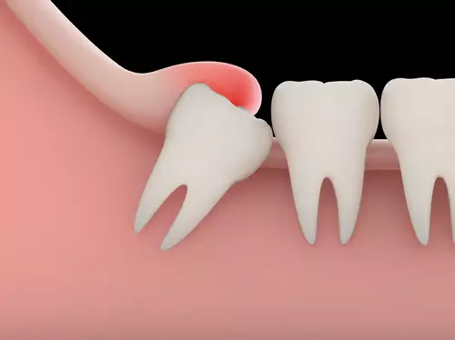 digital medical illustration of a tooth and gum